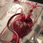 heart-transplant
