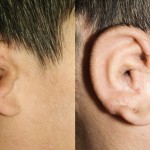 ear_reconstruction